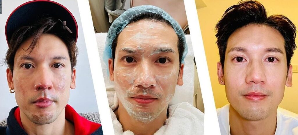 Kenny Kwan says he has healed from second-degree burns, celeb asia, kenny kwan, theHive.Asia