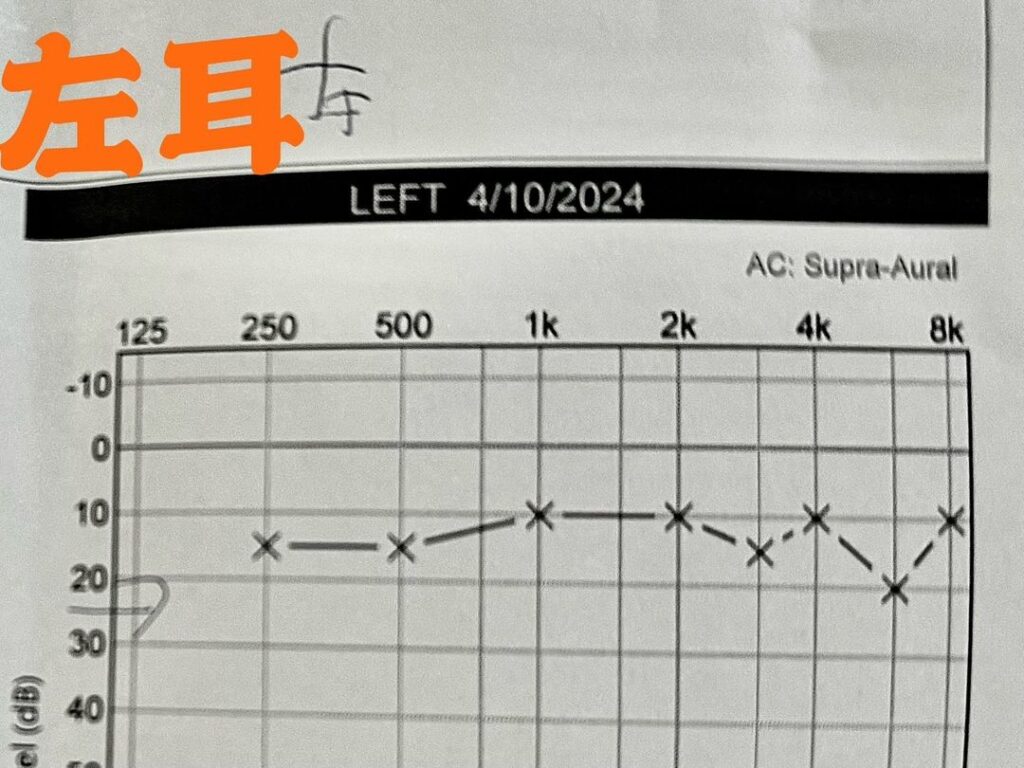 Leo Ku’s hearing issue is recovering well, celeb asia, leo ku, theHive.Asia, 關於中耳炎，多謝很多朋友的關心和慰問。和大家分享下康復情況，讓大家放心一下。前幾天覆診，做了耳內擷圖和聽力檢測。擷圖顯示耳膜耳道的發炎和耳瘡好了九成多，幾乎痊愈