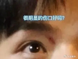 Fans slammed Gong Jun’s management over his minor injury | theHive.Asia Fans slammed Gong Jun’s management over his minor injury, celeb asia, gong jun, simon gong, theHive.Asia