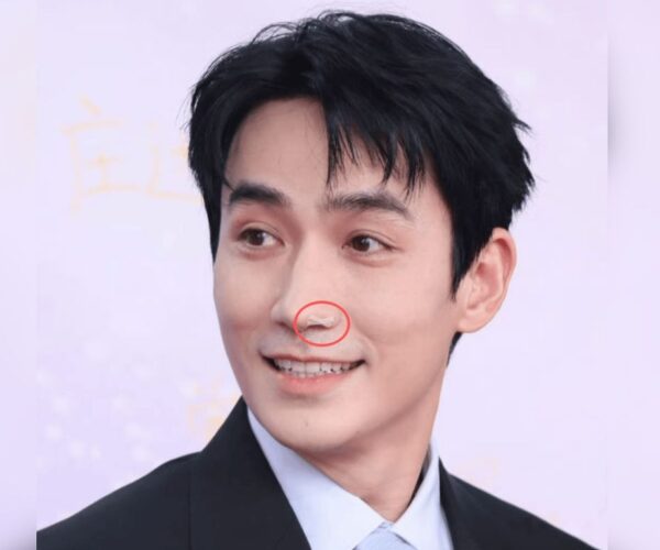 Zhu Yilong’s nose tape gets a clarification