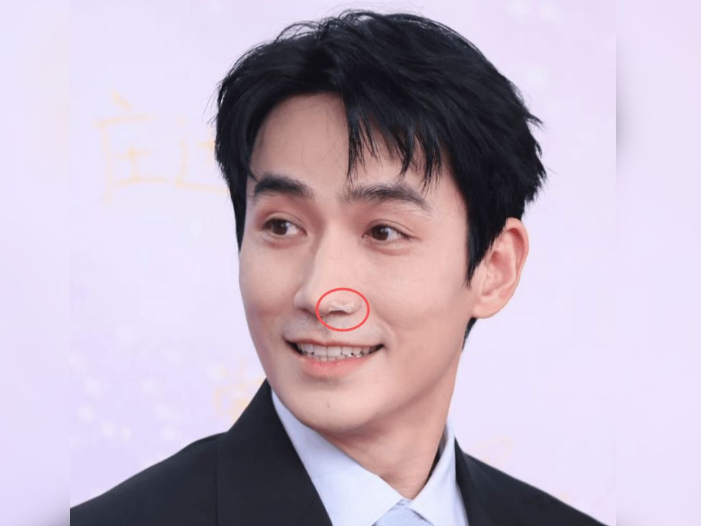 Zhu Yilong’s nose tape gets a clarification